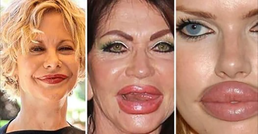 CELEBRIDADES 10 casos em que a REMODELAÇÃO LABIAL deram MUITO ERRADO